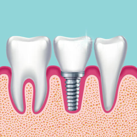 implant diagram