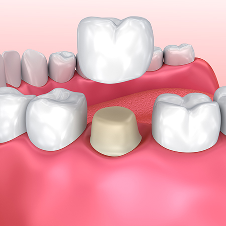 crown diagram