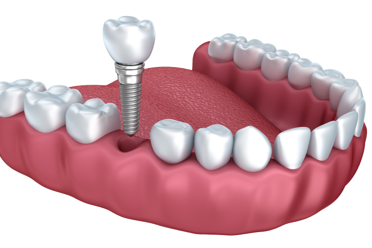 Rendering of a dental implant surgically implanted into the gums