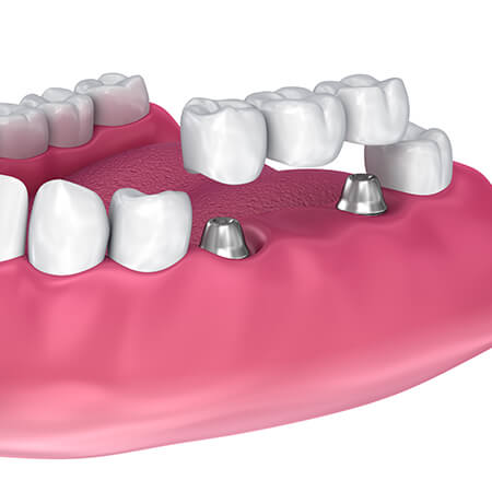 illustration of a dental bridge