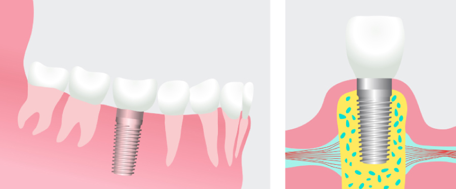 Illustration of a dental implant topped with a dental crown.