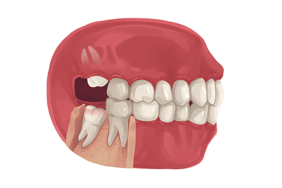 Model showing wisdom teeth growing in at odd angles.