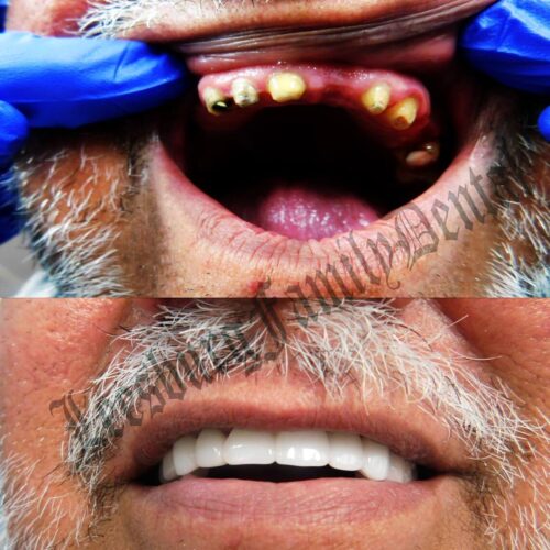 before/after Leesburg Family Dental dentist in Leesburg, Virginia Dr. Ali Mualla