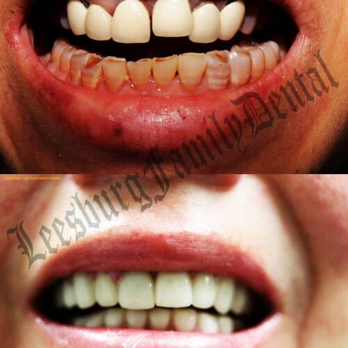 before/after Leesburg Family Dental dentist in Leesburg, Virginia Dr. Ali Mualla