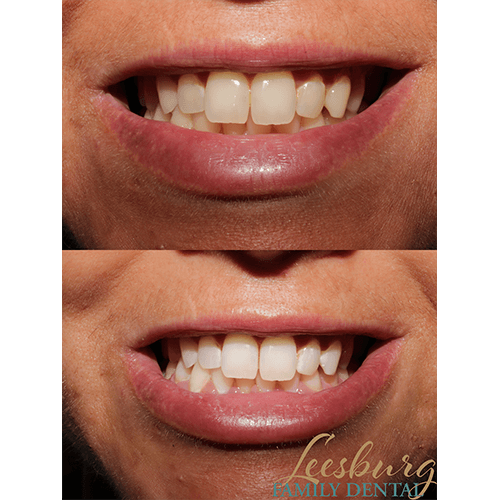 Before and after teeth whitening Leesburg Family Dental dentist in Leesburg, Virginia Dr. Ali Mualla