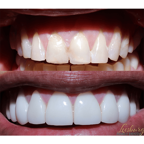 Before and after veneers Leesburg Family Dental dentist in Leesburg, Virginia Dr. Ali Mualla