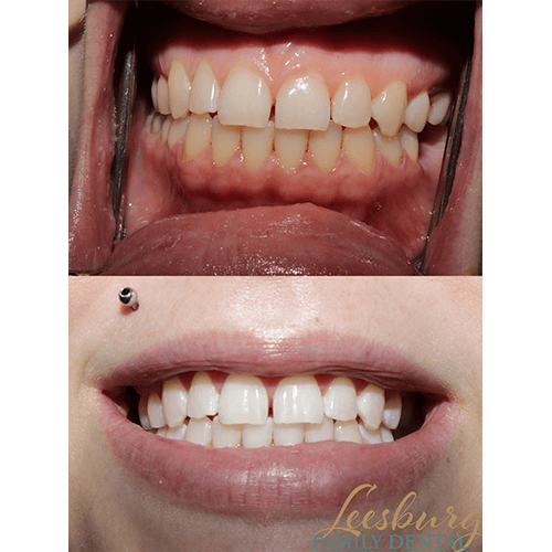 Before and after teeth whitening vLeesburg Family Dental dentist in Leesburg, Virginia Dr. Ali Mualla