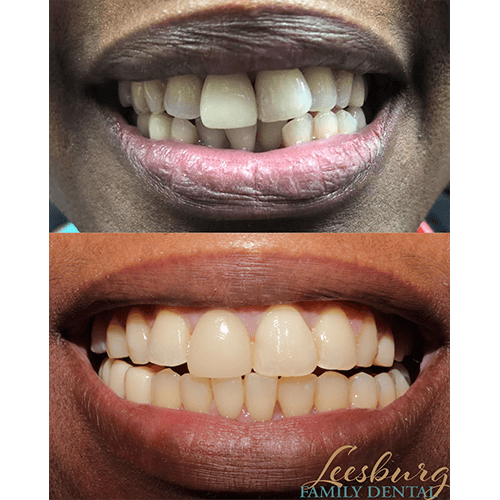 Before and after dental work Leesburg Family Dental dentist in Leesburg, Virginia Dr. Ali Mualla