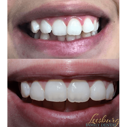 Before and after teeth restoration