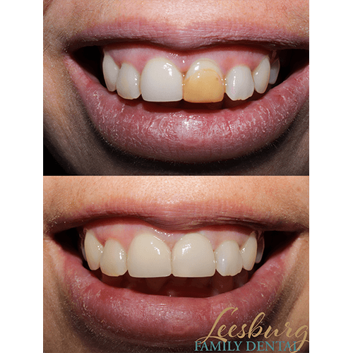 Before and after tooth repair Leesburg Family Dental dentist in Leesburg, Virginia Dr. Ali Mualla